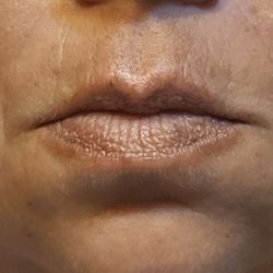 Allure Laser & Day Spa - About a hour later