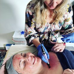Whitefish Creative Aesthetics - PRF micro-needling