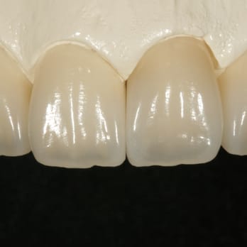 DenTech International - Porcelain Veneer - Medical Supplies Near Me - Irvine, California