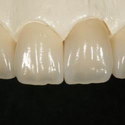 DenTech International - Porcelain Veneer