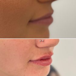 Organic Skin Studio - Lips enhancement with dermal filler