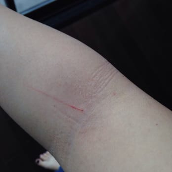 Houston Thyroid & Endocrine Specialists - Arm was scratch upon the needle pulled out by the nurse at the blood works room. - Endocrinologists Near Me - Bellaire, Texas Houston Thyroid & Endocrine Specialists - Arm was scratch upon the needle pulled out by the nurse at the blood works room. - Endocrinologists Near Me - Bellaire, Texas