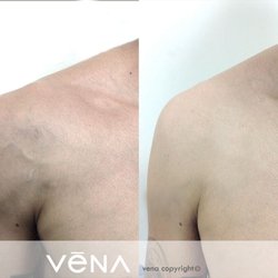 Vena Vein Clinic - Sherman oaks - Chest veins treatment at VeNA