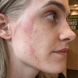 Ulta Beauty - Burns on my face, one of many (: