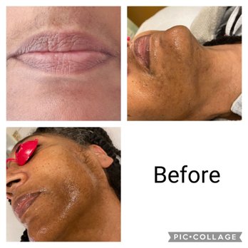 Sojourn Day Spa - Ana is treating my discoloration first - Day Spas Near Me - Atlanta, Georgia Sojourn Day Spa - Ana is treating my discoloration first - Day Spas Near Me - Atlanta, Georgia