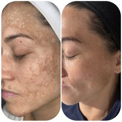Nurse Karen - Before and after Chemical Peels
