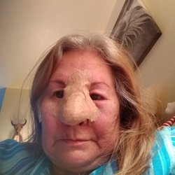 Penn State Dermatology - Several days after my torture!
