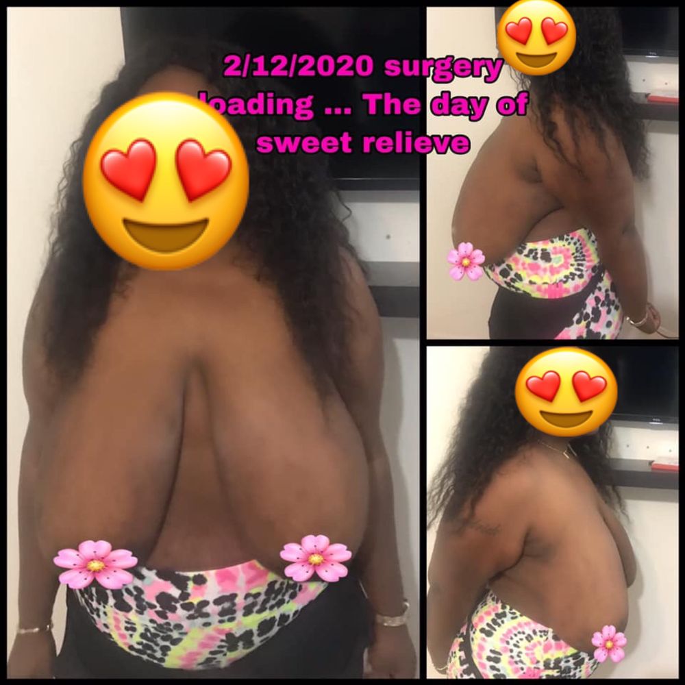 Lisa J Learn - Before Dr. Lisa Learn Transform my life 2/12/2020 big saggy breast to a more youthful perky new breast that I love so so much!!!! - Plastic Surgeons Near Me - Fort Lauderdale, Florida Lisa J Learn - Before Dr. Lisa Learn Transform my life 2/12/2020 big saggy breast to a more youthful perky new breast that I love so so much!!!! - Plastic Surgeons Near Me - Fort Lauderdale, Florida