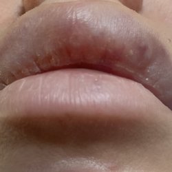 Revitalessence Medical Spa & Laser Center - Here is the before with Shelby