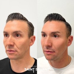 Saint Savant Medical Aesthetics - Nonsurgical MALE FACIAL BALANCING, RESTORED lost VOLUME using dermal filler