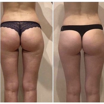 Endospheres Brooklyn - Body Contouring Near Me - Brooklyn, New York Endospheres Brooklyn - Body Contouring Near Me - Brooklyn, New York