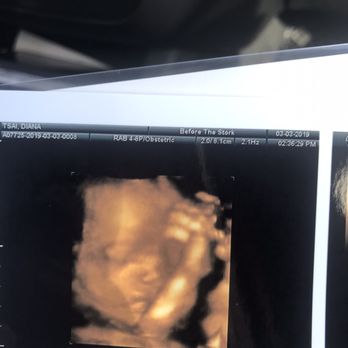 Before the Stork 4D - My baby girl - Ultrasound Imaging Centers Near Me - Anaheim, California Before the Stork 4D - My baby girl - Ultrasound Imaging Centers Near Me - Anaheim, California