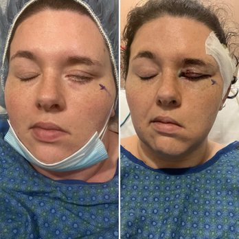 Overlake Medical Center - Eyelid surgery before and after - Hospitals Near Me - Bellevue, Washington Overlake Medical Center - Eyelid surgery before and after - Hospitals Near Me - Bellevue, Washington
