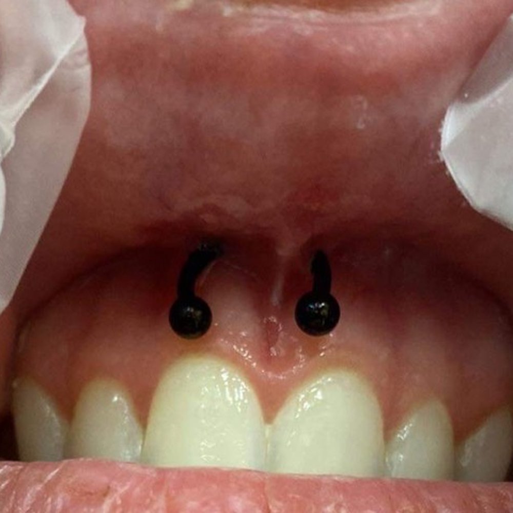 here is my smiley this was the worst one. it was very painful and i noticed it was crooked the next day when the swelling went down.