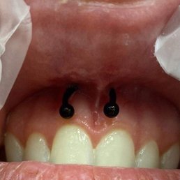 here is my smiley this was the worst one. it was very painful and i noticed it was crooked the next day when the swelling went down. here is my smiley this was the worst one. it was very painful and i noticed it was crooked the next day when the swelling went down.