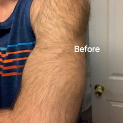 Laser Smooth - Before laser hair removal on arms.