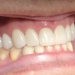 Precision Dental - Corrected bite