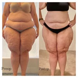 Liza Kim, MD - Before and after 2 Lipedema removal surgeries