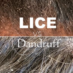 Lice Moms - Dandruff vs Lice: A key distinction lies in the fact that dandruff is flaky and mobile, while nits are securely glued to the hair shaft