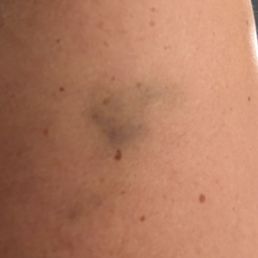 Bruises caused by my massage therapist not using lighter pressure as requestes Bruises caused by my massage therapist not using lighter pressure as requestes