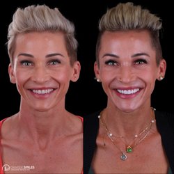 Draper Smiles - Smile Makeover with Composite Bonding Veneers