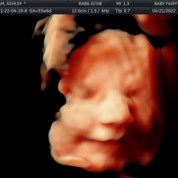 Baby Fairytale - My beautiful baby boy. One of the many images I got that I will cherish forever. - Ultrasound Imaging Centers Near Me - Rockledge, Florida Baby Fairytale - My beautiful baby boy. One of the many images I got that I will cherish forever. - Ultrasound Imaging Centers Near Me - Rockledge, Florida