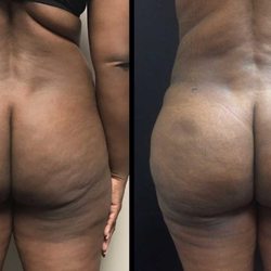 Jude LaBarbera, MD - Before and one week after undergoing circumferential liposuction with fat transfer to the buttock (Brazilian Butt Lift).