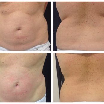 Smooth Silhouette - Before and after 4 treatments - Skin Care Near Me - Manhattan Beach, California Smooth Silhouette - Before and after 4 treatments - Skin Care Near Me - Manhattan Beach, California
