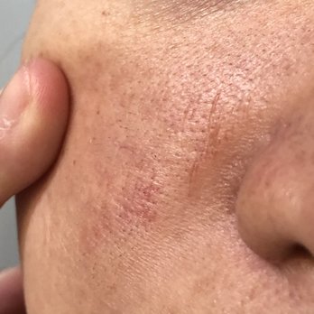 étant - Cuts from dermaplaning - Skin Care Near Me - Boston, Massachusetts
