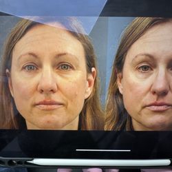 Christine Petti MD, FACS - Me: left after, right before