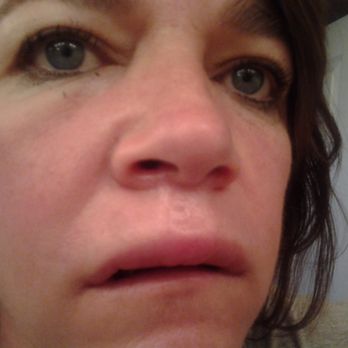 Dental Magic - This is what my face looked after the procedure and they acted like it was perfectly normal. - Cosmetic Dentists Near Me - Citrus Heights, California Dental Magic - This is what my face looked after the procedure and they acted like it was perfectly normal. - Cosmetic Dentists Near Me - Citrus Heights, California