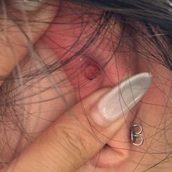 Lovisa - Infected helix piercing keloid puss bump