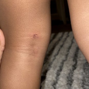 Childcare Network - Bite mark in healing stage - Preschools Near Me - Pooler, Georgia