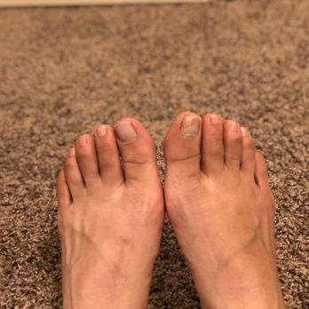 My Nails & Spa - I apologize in advance for this photo - fungus infection from a pedicure a week ago - Skin Care Near Me - Anaheim, California