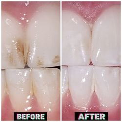 Mr. Glowman Teeth Illumination