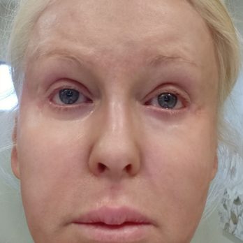 Robert Shumway, MD - No make-up pic that I took the day before my surgery. - Cosmetic Surgeons Near Me - San Diego, California Robert Shumway, MD - No make-up pic that I took the day before my surgery. - Cosmetic Surgeons Near Me - San Diego, California
