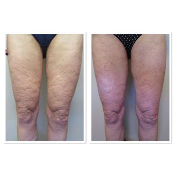 Michael S Mall, MD - Profound after two months ...This treatment renders the best results after six months. Call to find out how you can lift & tighten - Family Practice Near Me - Las Vegas, Nevada