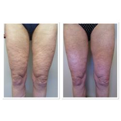 Michael S Mall, MD - Profound after two months ...This treatment renders the best results after six months. Call to find out how you can lift & tighten