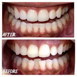 Orinda Dental Care - Invisalign Treatment ,  beautiful results in only 7 months