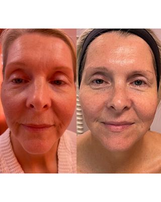 3 Advanced Plasma Treatments, 2 Age Defying Facials - Ready for transformation? This is one month after her 3rd *Advanced Plasma Treatment* and directly after her 2nd Age Defying Facial. GORGEOUS!!! We literally knocked atleast 10 years off of her face! So exciting!!! 😁
-No filler, No Toxins, No Needles, No Pain, No downtime, No Surgery! Just you! Simulate natural collagen regeneration, lift, smooth, tighten.
*Advanced Plasma Therapy* Total Rejuvenation!
Reduce signs of aging naturally by stimulating your own collagen and cell renewal for permanent results. This service utilizes the newest advancement in Plasma technology, combined with our very own protocol for the most amazing results! This Plasma technology uses multiple types of plasma energy and sends signals all the way down to the subcutaneous layer of the skin, telling collagen fibroblast sites to wake up and regenerate.
This premier technology has virtually no negative side effects. We’ve been experimenting for half a year developing our exclusive protocol before unveiling the quality that is, *Advanced Plasma Therapy*. We are so proud and know you will love it! You will see visible results from the first day forward and it will continue to enhance over the next 12 weeks… possibly up to a year, some studies say.
This service is done in a series of 3,5 or 8 and can then be repeated after 12 weeks if you like or just occasionally for maintenance and prevention of further degradation of the skin with the natural aging process. Each Plasma treatment alone provides up to 14.9% regeneration. Firm, tone, soften and lift. No fillers, no toxins, no needles, no downtime.
Are you ready to work towards the skin you love? Call us today, we offer 12 month, interest free financing. (215)862-2456
@puritiespanstudios 3 Advanced Plasma Treatments, 2 Age Defying Facials - Ready for transformation? This is one month after her 3rd *Advanced Plasma Treatment* and directly after her 2nd Age Defying Facial. GORGEOUS!!! We literally knocked atleast 10 years off of her face! So exciting!!! 😁
-No filler, No Toxins, No Needles, No Pain, No downtime, No Surgery! Just you! Simulate natural collagen regeneration, lift, smooth, tighten.
*Advanced Plasma Therapy* Total Rejuvenation!
Reduce signs of aging naturally by stimulating your own collagen and cell renewal for permanent results. This service utilizes the newest advancement in Plasma technology, combined with our very own protocol for the most amazing results! This Plasma technology uses multiple types of plasma energy and sends signals all the way down to the subcutaneous layer of the skin, telling collagen fibroblast sites to wake up and regenerate.
This premier technology has virtually no negative side effects. We’ve been experimenting for half a year developing our exclusive protocol before unveiling the quality that is, *Advanced Plasma Therapy*. We are so proud and know you will love it! You will see visible results from the first day forward and it will continue to enhance over the next 12 weeks… possibly up to a year, some studies say.
This service is done in a series of 3,5 or 8 and can then be repeated after 12 weeks if you like or just occasionally for maintenance and prevention of further degradation of the skin with the natural aging process. Each Plasma treatment alone provides up to 14.9% regeneration. Firm, tone, soften and lift. No fillers, no toxins, no needles, no downtime.
Are you ready to work towards the skin you love? Call us today, we offer 12 month, interest free financing. (215)862-2456
@puritiespanstudios