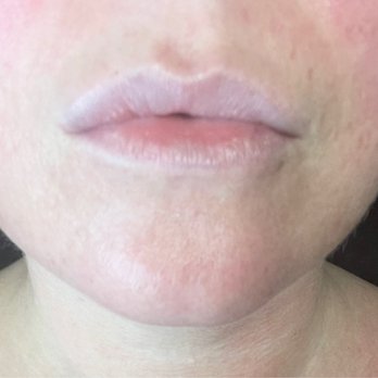 Pretty Please By KT - Before lip filler - Skin Care Near Me Pretty Please By KT - Before lip filler - Skin Care Near Me