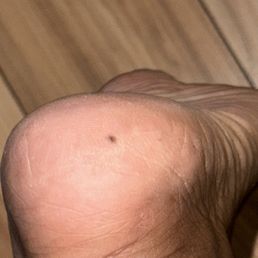 Dead skin on my feet
