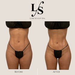 Luxe Sculpt Spa - Before and After 1 Luxe Sculpt Drainage Massage