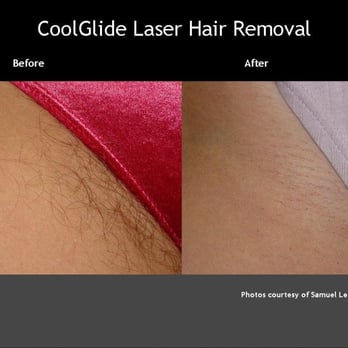 Pacifica Medical Spa - Laser Hair Removal- Bikini - Medical Spas Near Me - Studio City, California Pacifica Medical Spa - Laser Hair Removal- Bikini - Medical Spas Near Me - Studio City, California