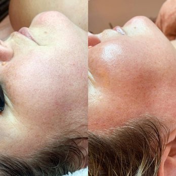 Devon Michelle Skin Care - Before/After of Dermaplaning and Hydro Facial + LED Red Light Therapy - Acne Treatment Near Me - El Segundo, California Devon Michelle Skin Care - Before/After of Dermaplaning and Hydro Facial + LED Red Light Therapy - Acne Treatment Near Me - El Segundo, California