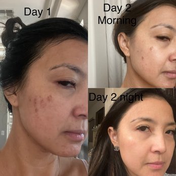 Laser Options By Jen - After 2nd treatment of VivaVenus RF - Medical Spas Near Me - Scottsdale, Arizona Laser Options By Jen - After 2nd treatment of VivaVenus RF - Medical Spas Near Me - Scottsdale, Arizona