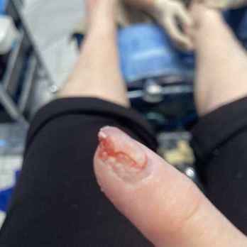 The New Place Nails - My pinky after she ripped my quick. - Nail Salons Near Me - Somersworth, New Hampshire The New Place Nails - My pinky after she ripped my quick. - Nail Salons Near Me - Somersworth, New Hampshire