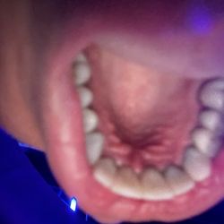 Damaged my gums beware