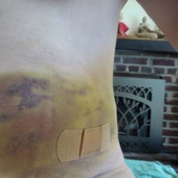 Paul D Costas, MD - RESULTS OF LIPOSUCTION DONE TO PLUMP THE FACE WITH THE TUMMY FAT. NO CHANGE IN FACE POST OPERATION. DEVASTATED
