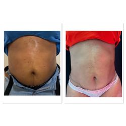 Body Contouring